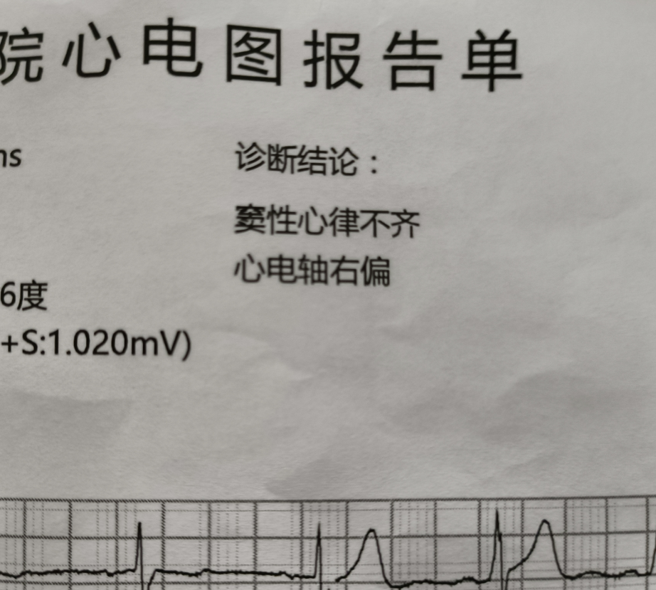 心电图